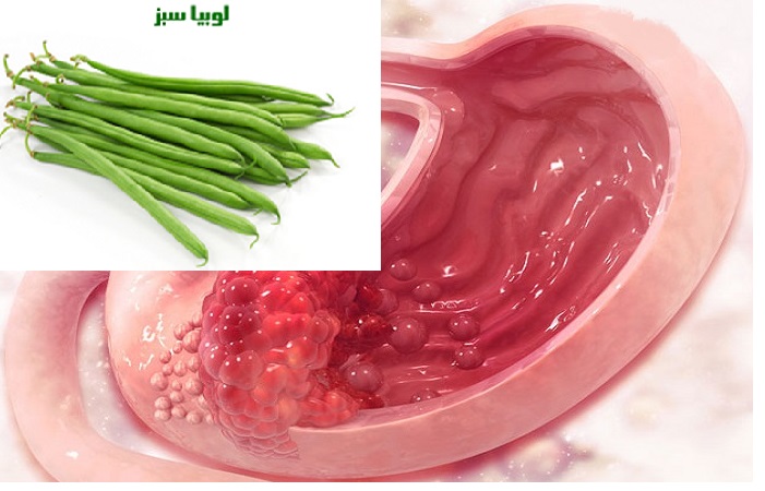 پیشگیری از سرطان با مصرف لوبیا سبز